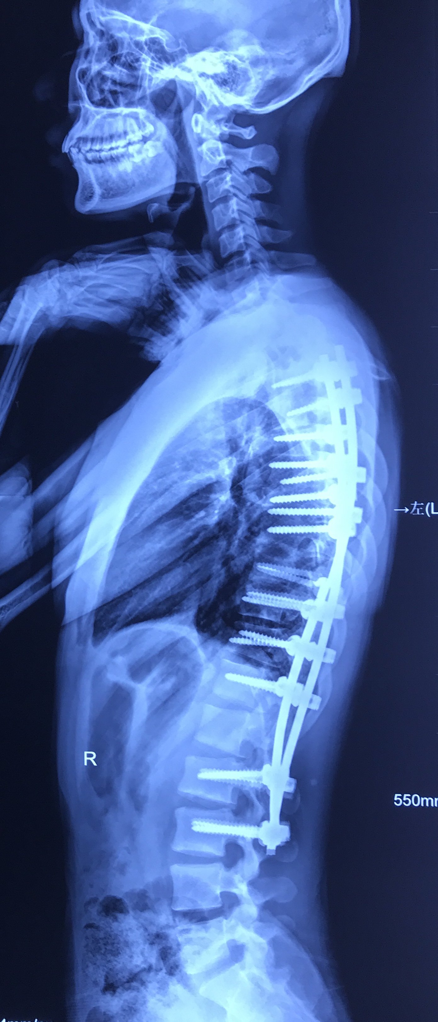 脊柱侧弯手术需谨慎 早期治疗是“王道”
