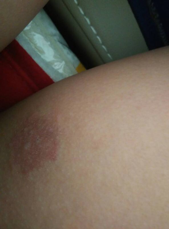 女性股癣的原因，体癣可以自愈吗？指南上的治疗方法