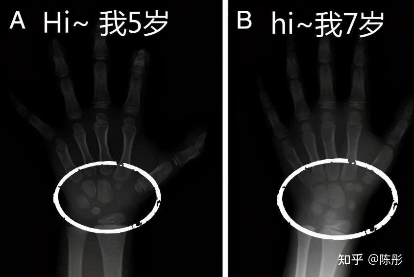 开灯睡觉影响孩子长个，是真的吗？深圳小米熊 吴依阳主任